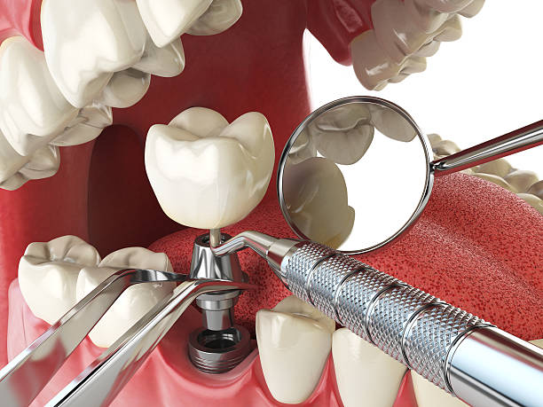 Best Emergency Denture Repair in Stansberry Lake, WA
